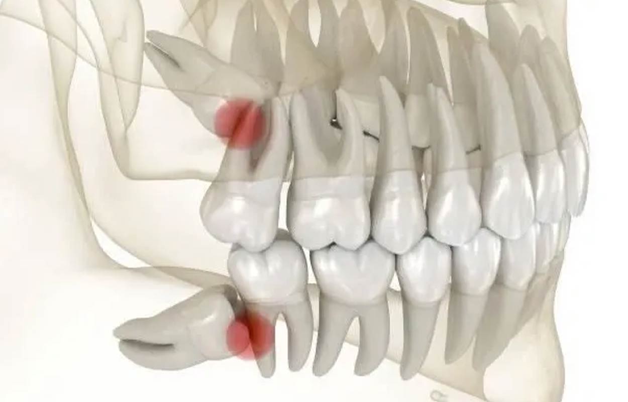 Tooth Extractions Alcan Family Dental, Same Day Dental Crown Anchorage AK, Family Dental Clinic Anchorage AK, Emergency Dental Care Anchorage AK, Emergency Dental Services Anchorage AK, Dentist Office Anchorage AK, Anchorage Dentures Medicaid, Emergency Dentures Anchorage